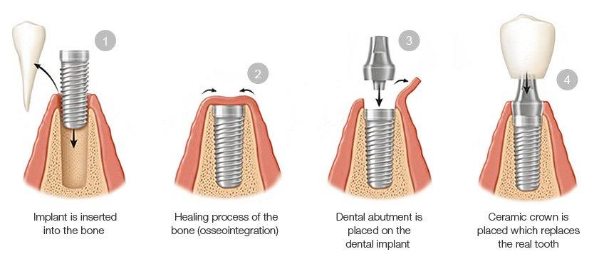 4 steps for a Dental Implant in Singapore