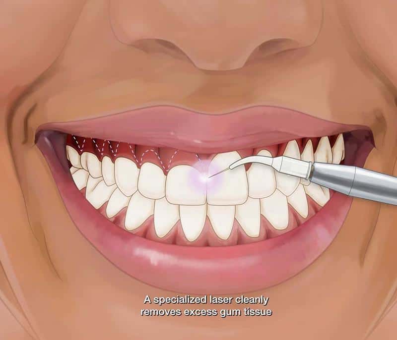 Aesthetic Gum Lift3 | Elite Dental Group
