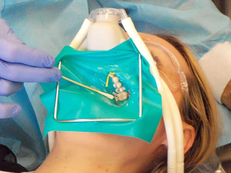 Biological Removal of Mercury Fillings 2 | Elite Dental Group