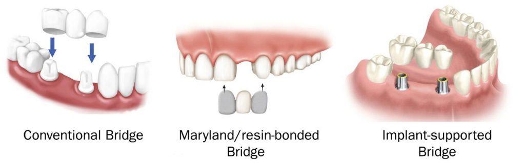 Dental Bridges2 | Elite Dental Group