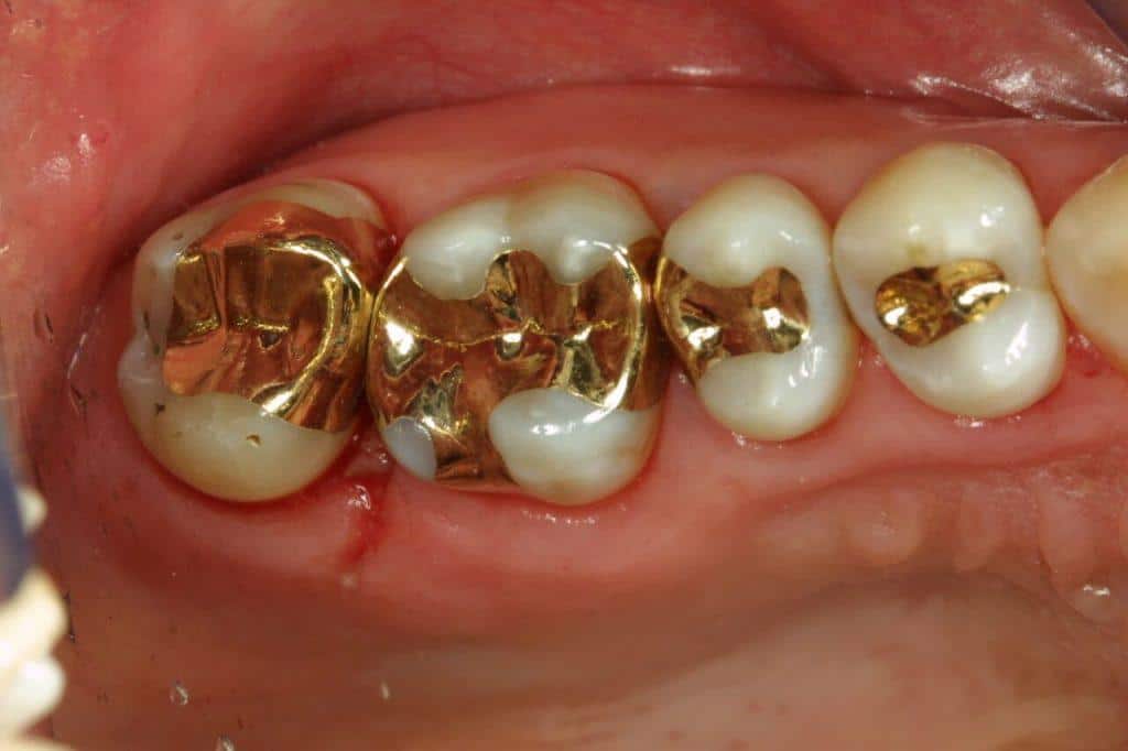 Dental InlaysOnlays 1 | Elite Dental Group