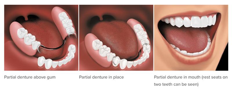 Removable Dentures2 | Elite Dental Group