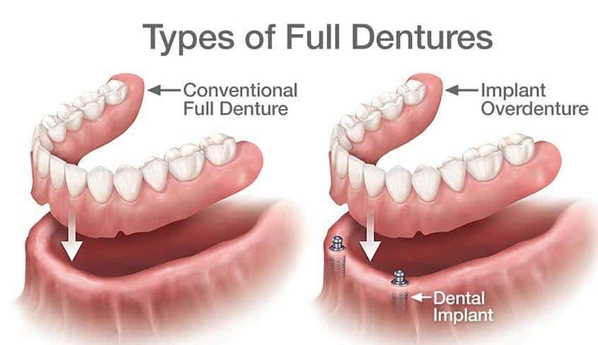 Removable Dentures3 | Elite Dental Group