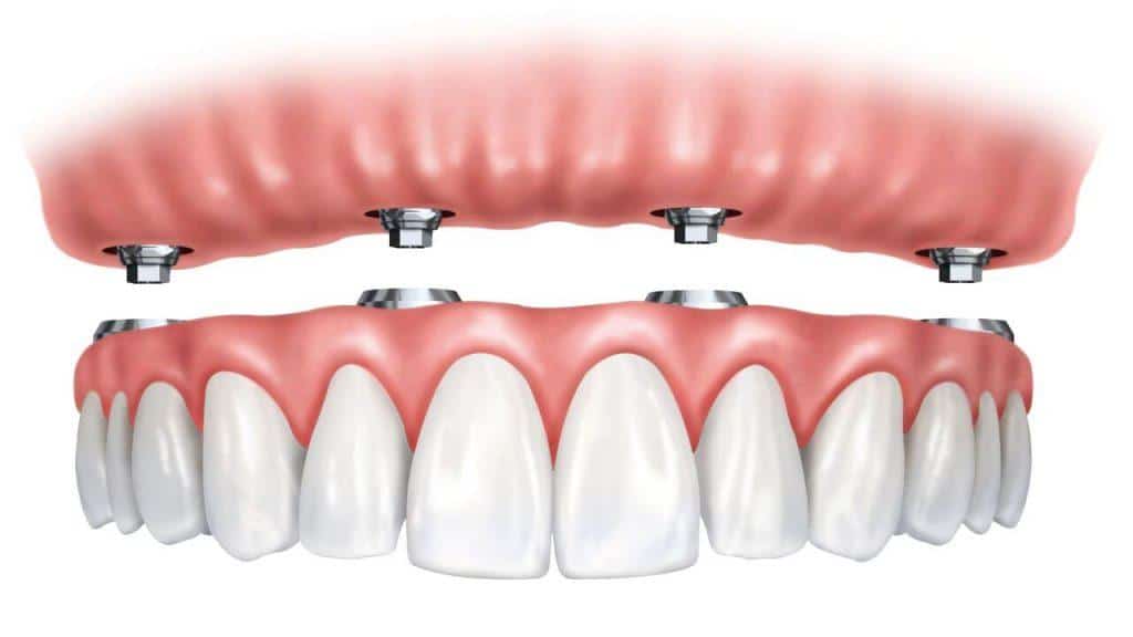 Removable Dentures4 | Elite Dental Group