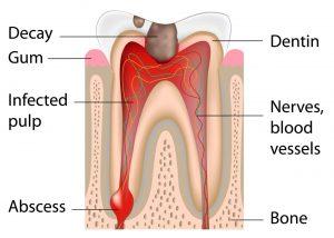 Root Canal Treatment Process