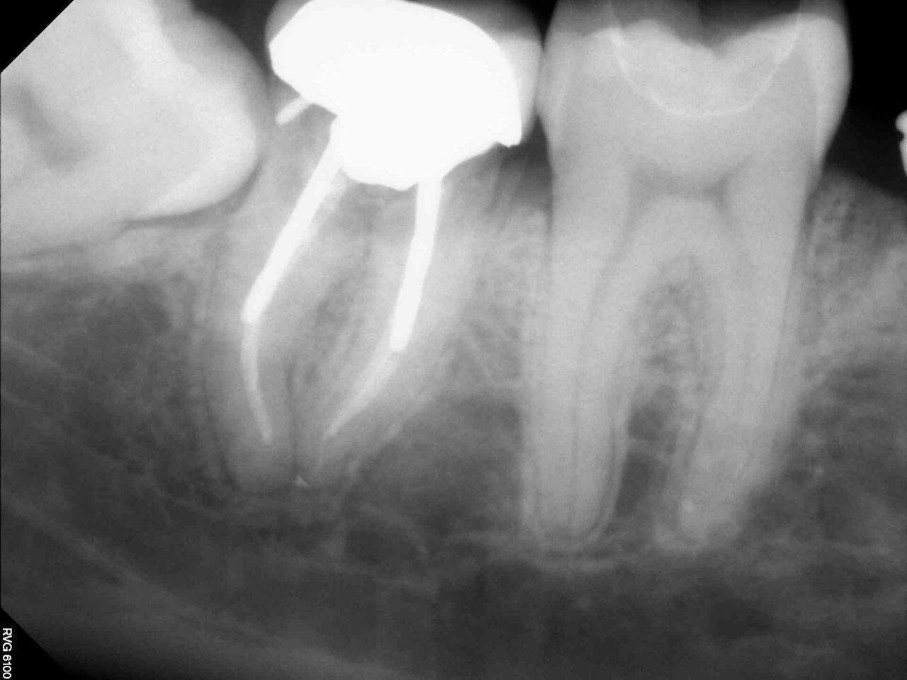 Is root canal treatment painful? Image of a root canal treatment X-ray.
