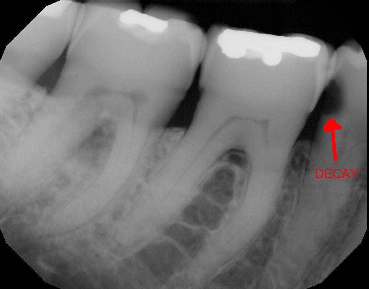 Tooth colored dental fillings3 | Elite Dental Group