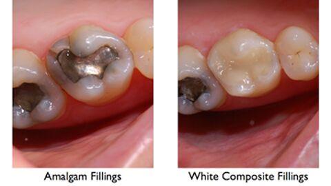 Tooth colored dental fillings4 | Elite Dental Group