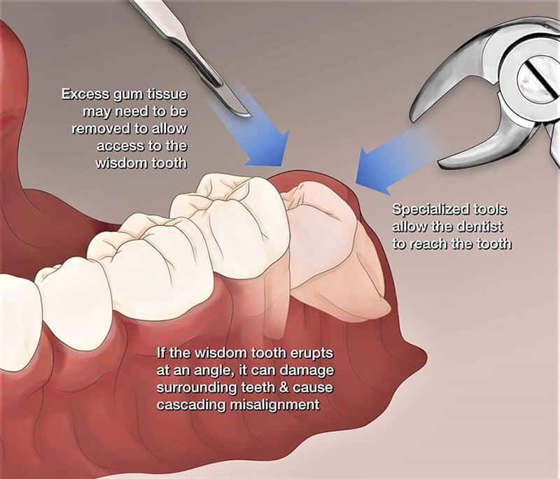 Wisdom Tooth Surgery | Elite Dental Group