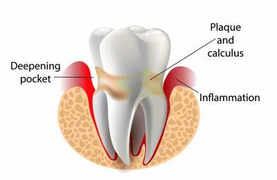 Deep Gum Cleaning: Improve Gum Health | Elite Dental Group