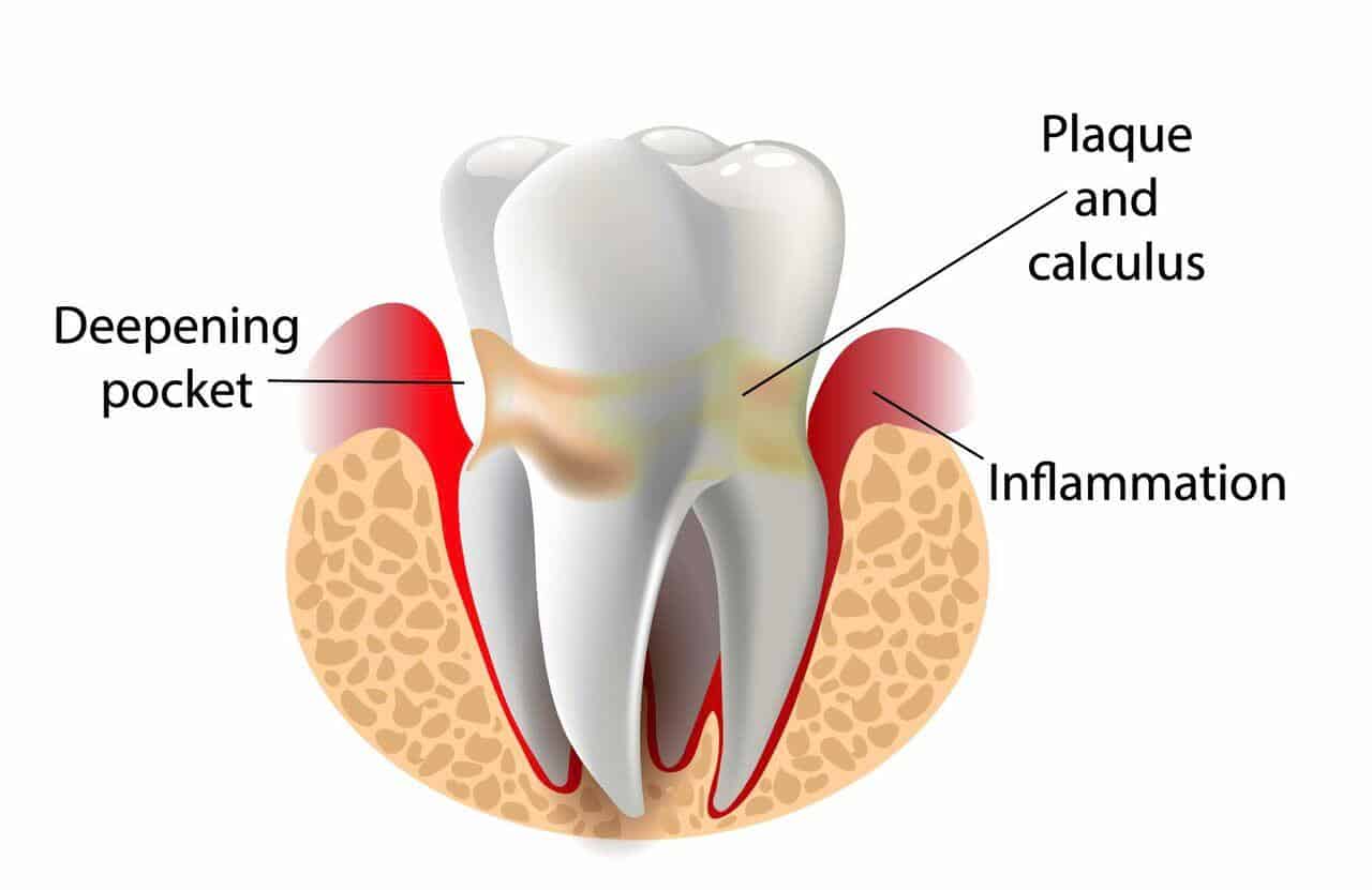 Deep Gum Cleaning Improve Gum Health Elite Dental Group