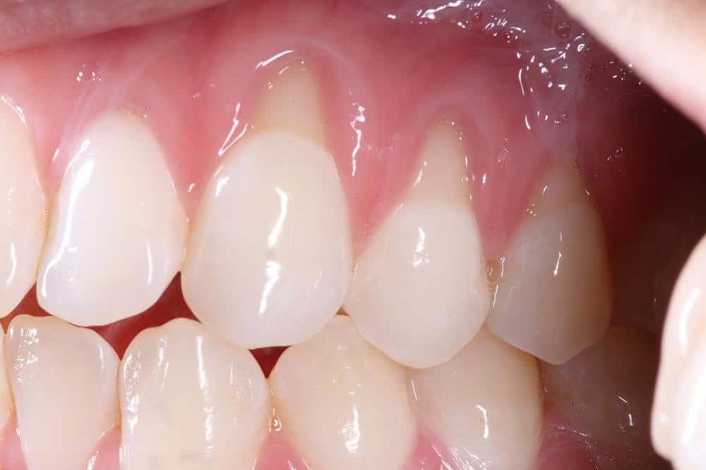 Gum grafting | Elite Dental Group