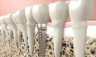 Dental implants Singapore