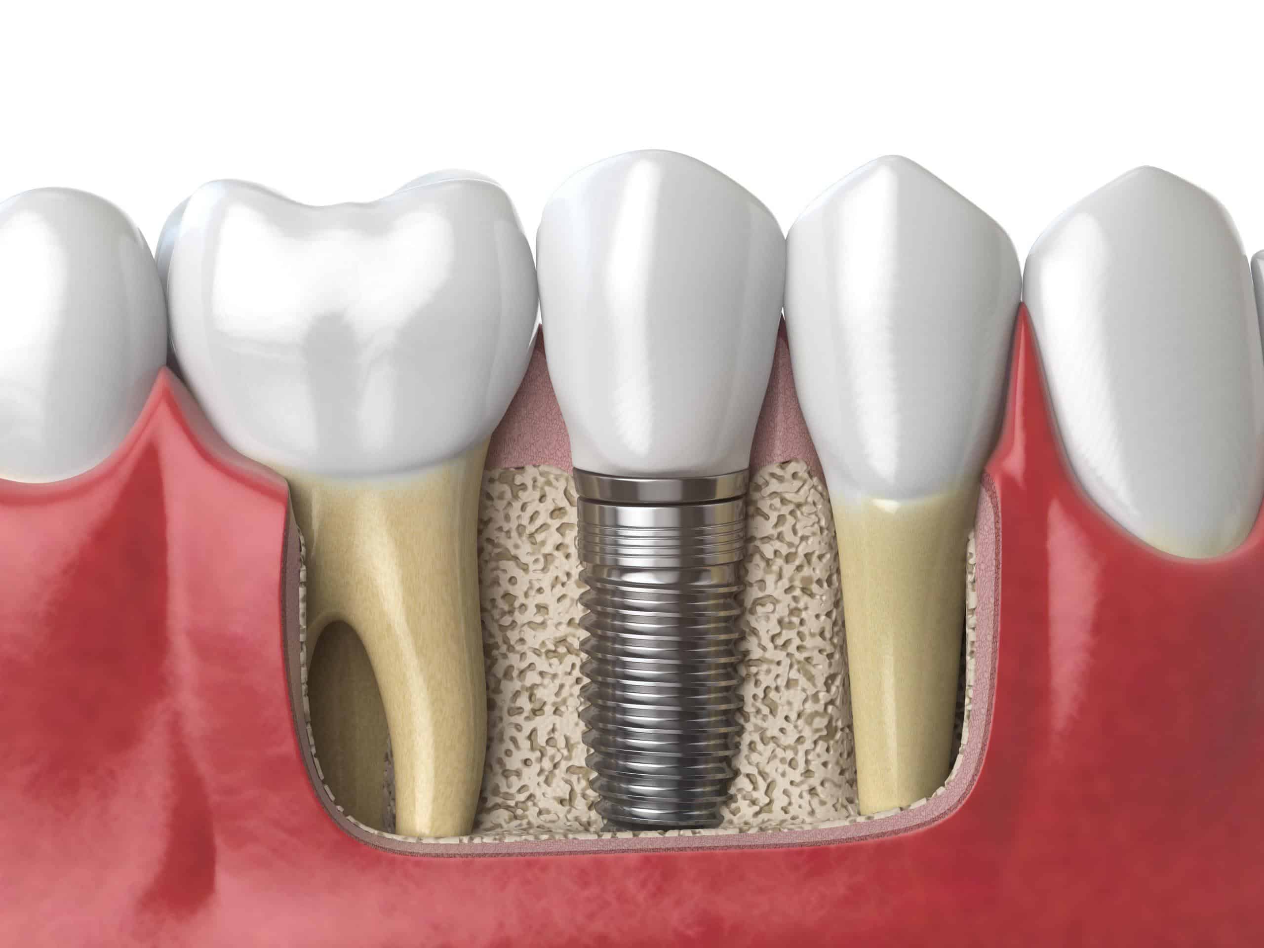 dental implants in Singapore