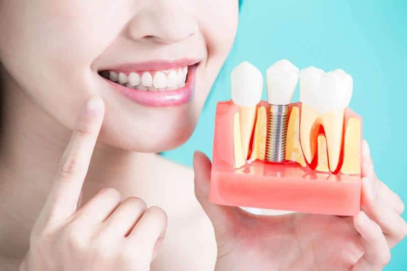 dental implants information | Elite Dental Group