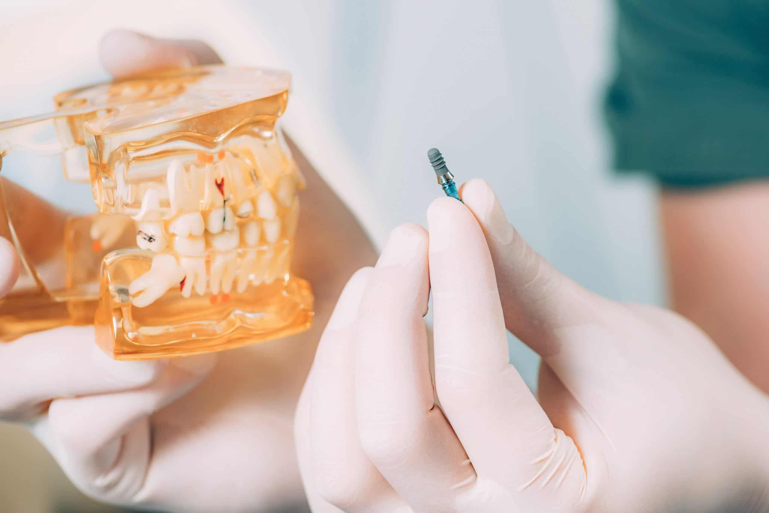 dental implants Singapore