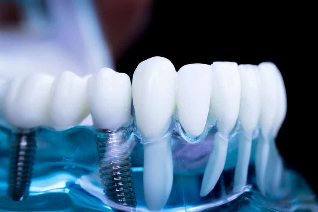 dental implant surgeon in Singapore