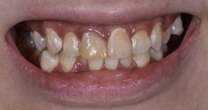 Discoloured teeth - Elite Dental Group