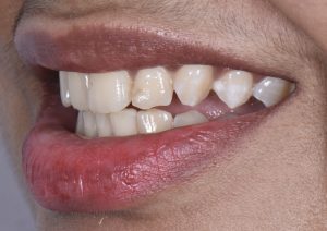 Chipped tooth - Elite Dental Group