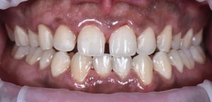 Gaps between teeth - Elite Dental Group