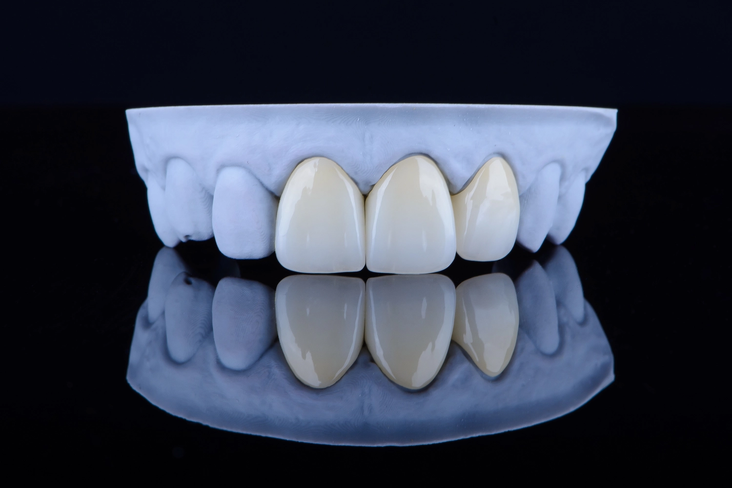 Composite Dental Veneers