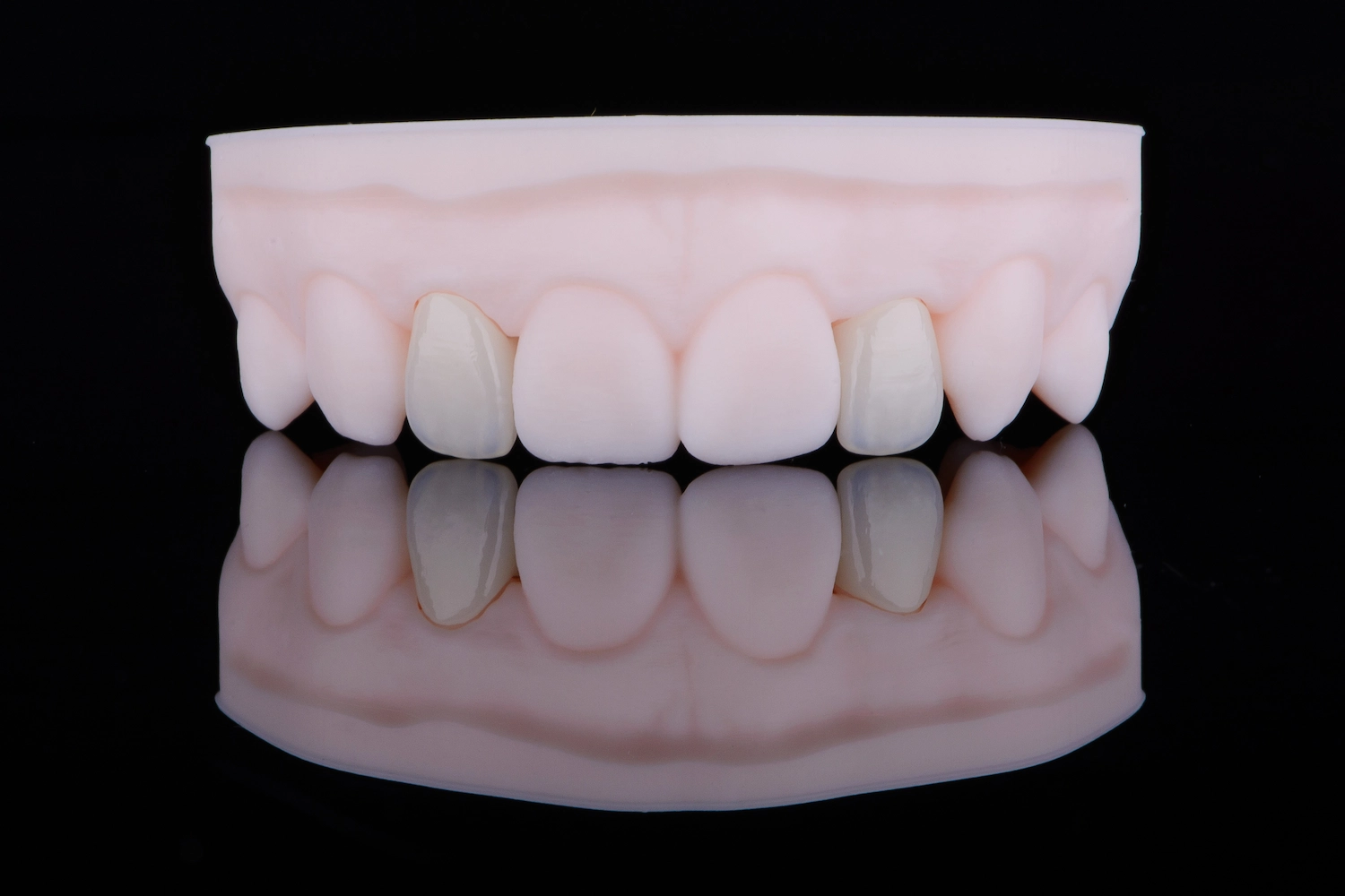 Porcelain Ceramic Dental Veneers