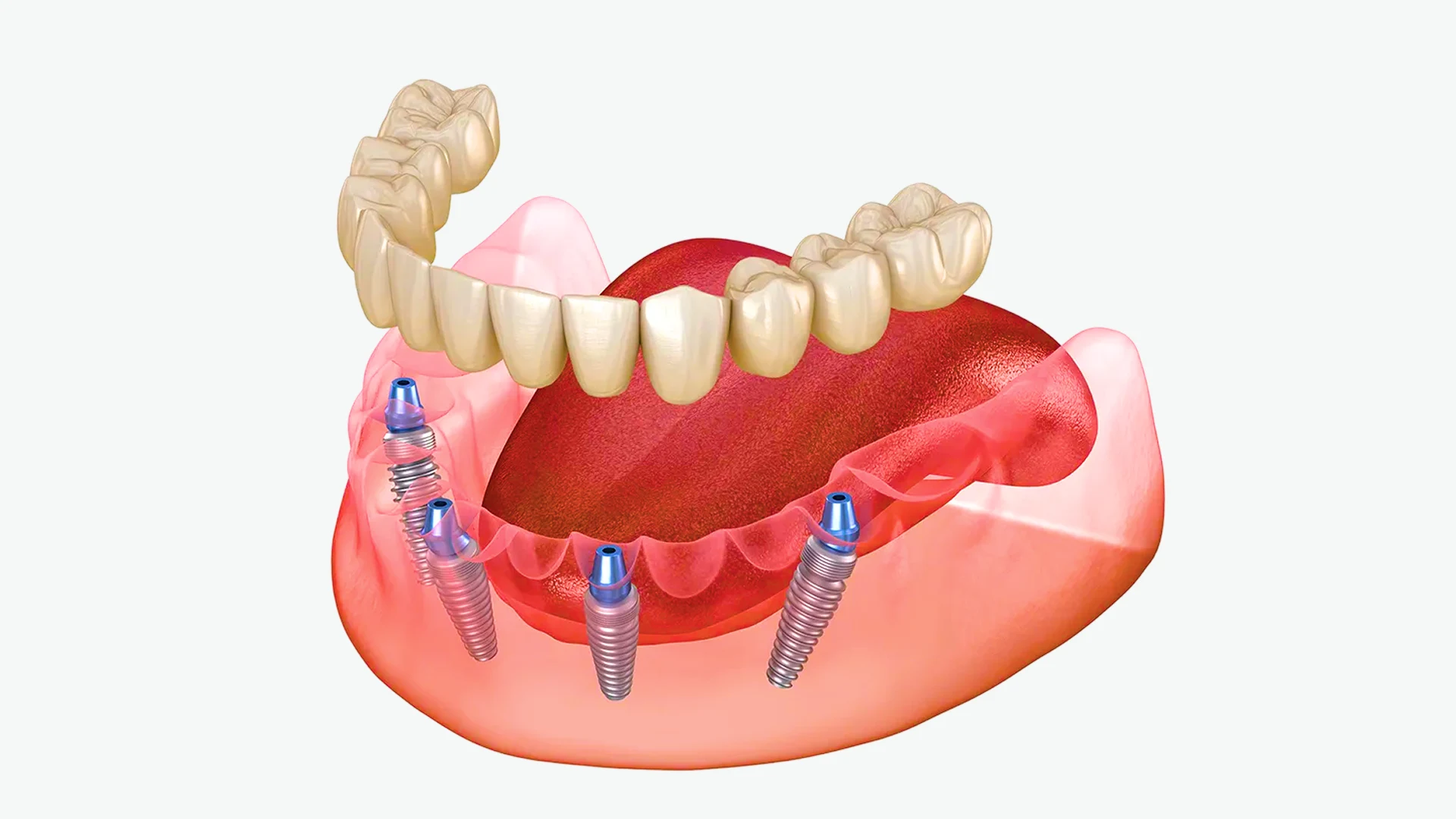 all-on-4_img