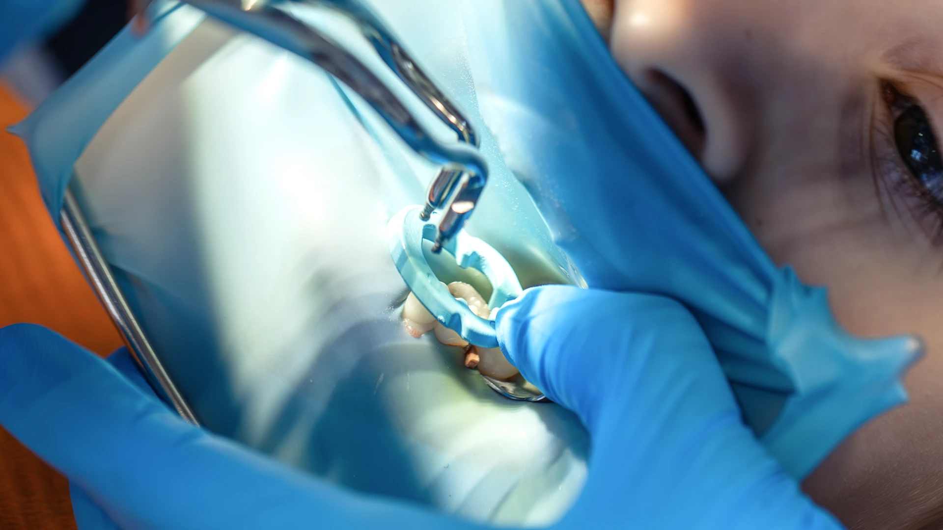 tooth-extraction_img