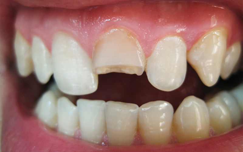 A close-up view of a person's teeth showing a fractured or broken upper front incisor.