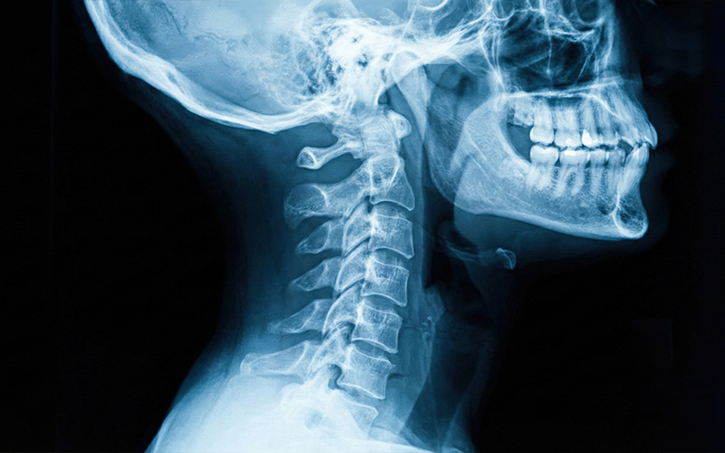 Lateral X-ray of head and neck.