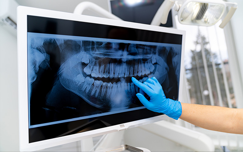 Dental professional pointing at panoramic X-ray.