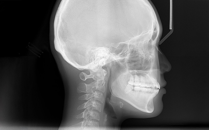 A lateral cephalometric X-ray showing a side profile view of a human skull, jaw, and cervical vertebrae.