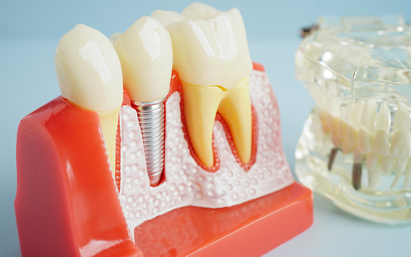 Artificial tooth roots dental implant into jaw Root canal model for dentist