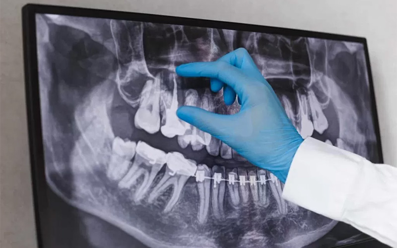 Gloved hand points at dental X‑ray showing teeth with braces.