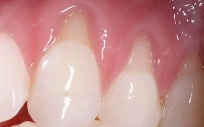 Extreme close-up of receding gums exposing tooth roots.