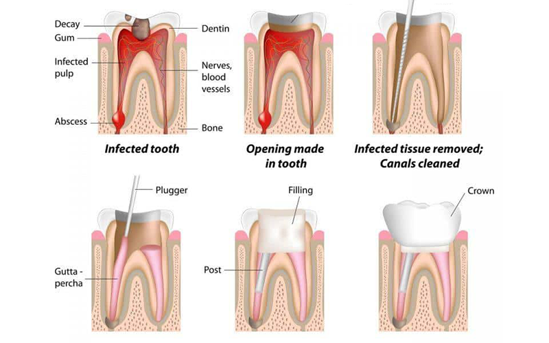 Root canal procedure steps to treat infected tooth pulp.
