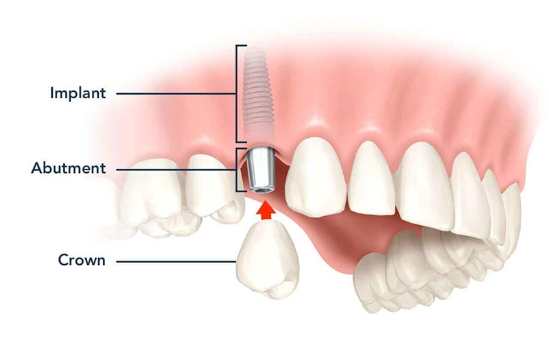 Diagram showing dental implant, abutment, and crown components.