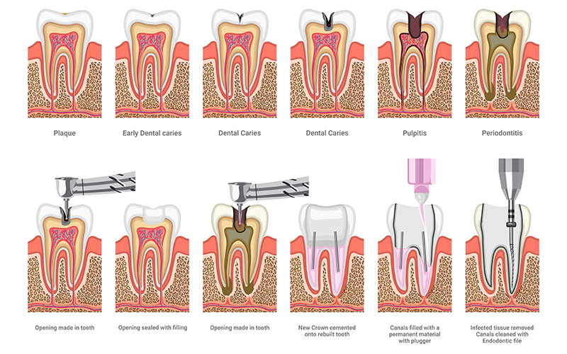 root canal treatment guide