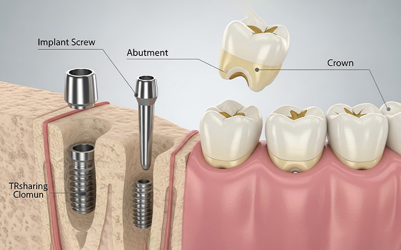 dental implant and crowning parts