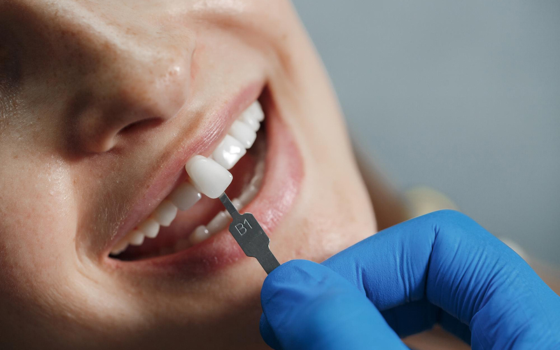 Dentist matching tooth shade for potential porcelain veneer application.