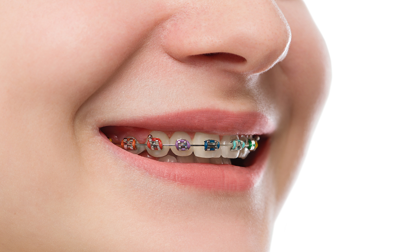 Patient wearing colorful dental braces as a veneer alternative.