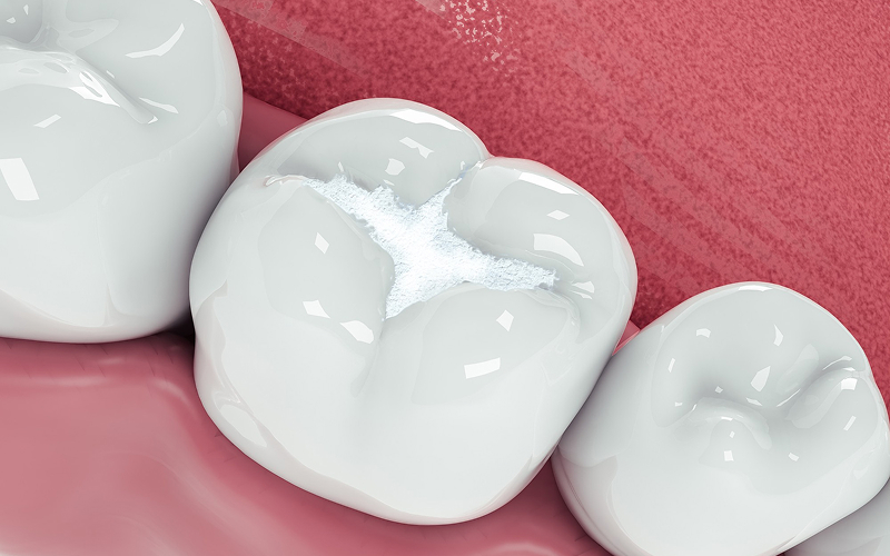 Close-up illustration of a composite dental filling on a molar.