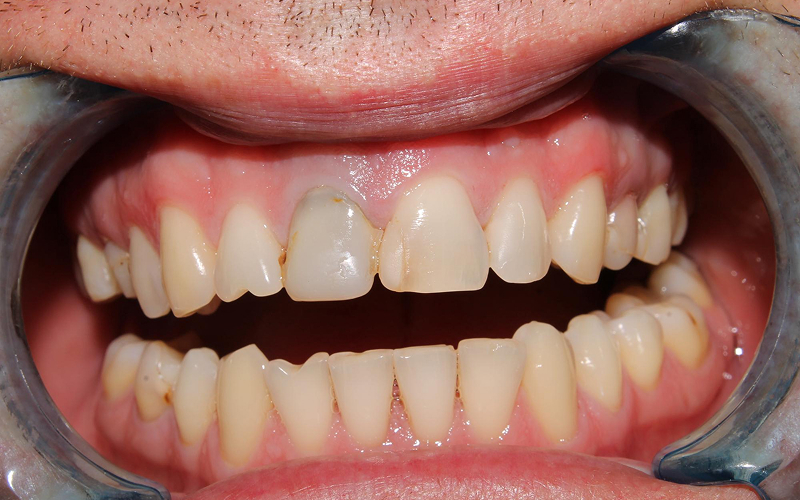 Close-up of brown dental stains and discoloured front teeth.