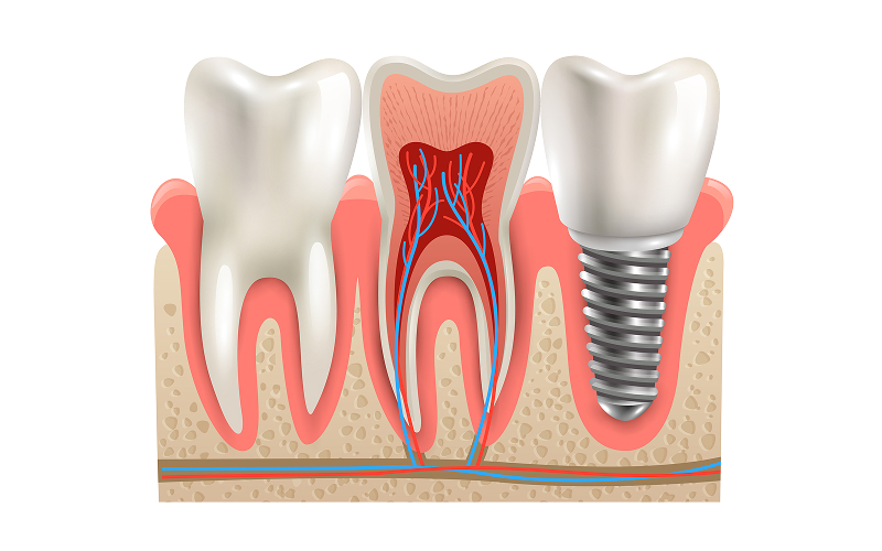 Diagram comparing natural teeth with a dental implant structure.