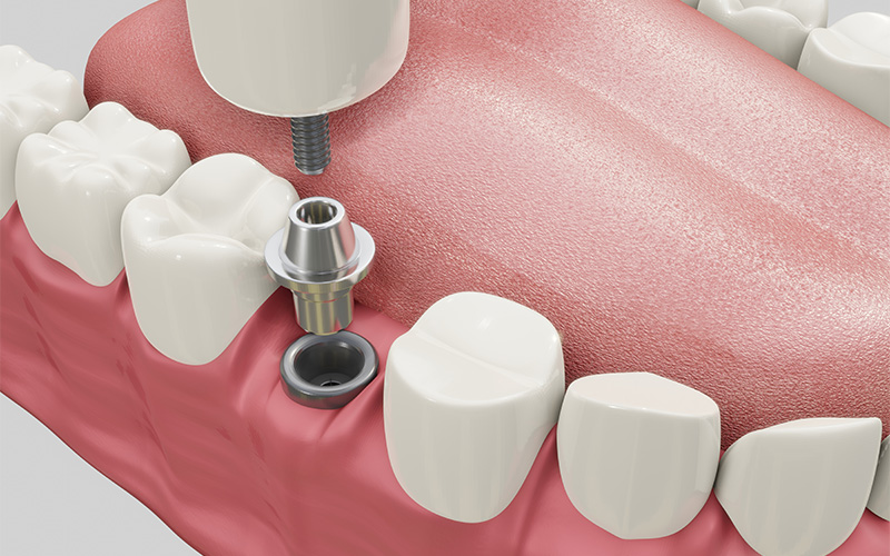3D diagram showing standard dental implant placement process.