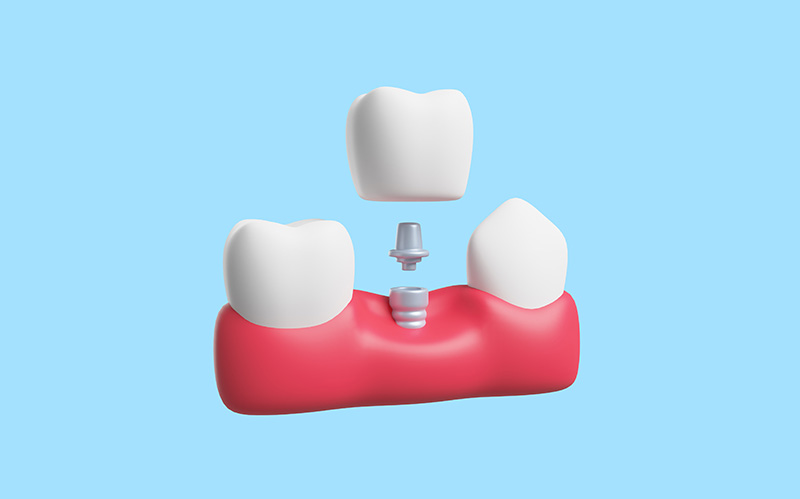 3D Model Of Human Gums And Dental Implant With Blue Background