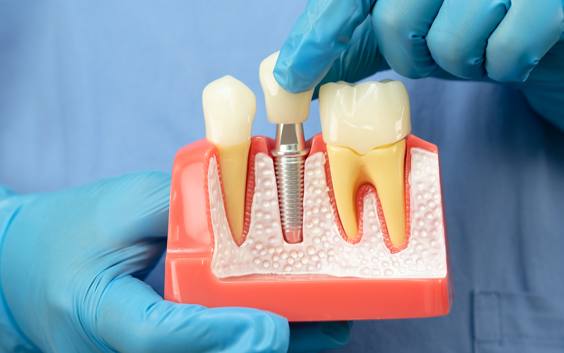 Hands in gloves holding a dental implant model.